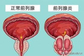 经常“打飞机”？小心‘乐’极生悲，尿频尿急、尿痛都找上门！ 