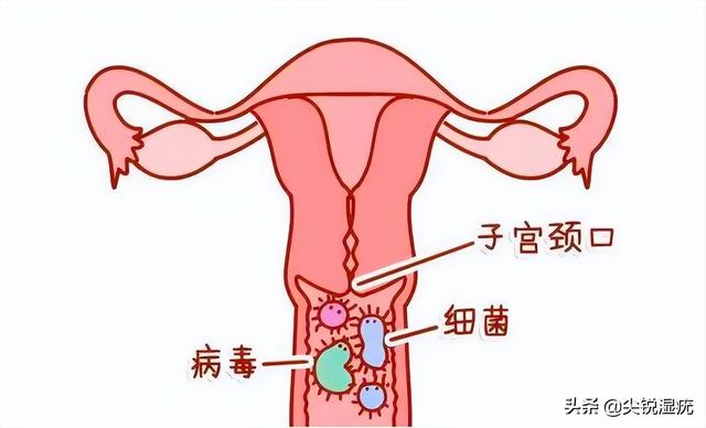 宫颈湿锐尤典型图片 