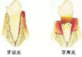 牙医的良心忠告：这些情况会增加种植牙失败的风险 