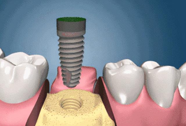 种植牙只有好没有坏吗？老牙医告诉你，种植牙的这些坏处不可避免 