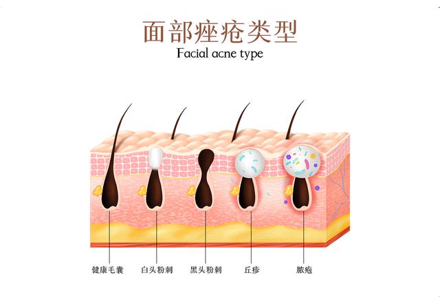 脸上长痘痘应该怎么治疗？现在告诉你方法，千万别乱挤 