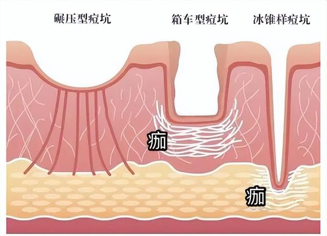 从“毁容”到皮肤光滑平整，3年的“痘坑”终于好了 