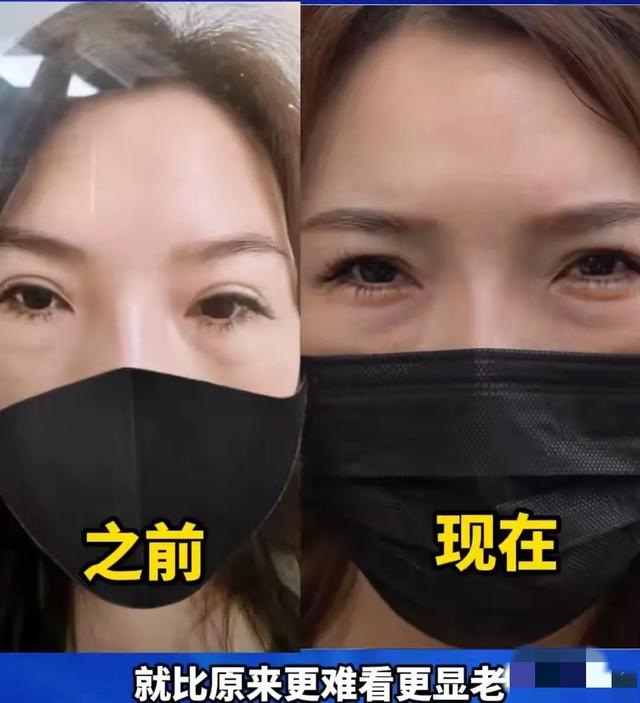 美容陷阱！女子竟在超市做眼袋切除术，后果太吓人，黑医美摊大事 