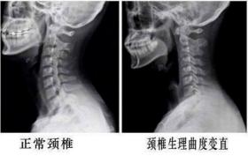 颈椎变直还有救吗？自我康复的动作，其实很简单 