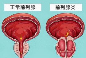 &quot;打飞机&quot;后，排尿困难，尿痛，是前列腺出问题了？ 