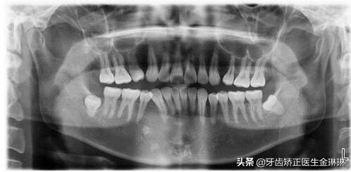 淄博拔智齿收费价目表拔牙 