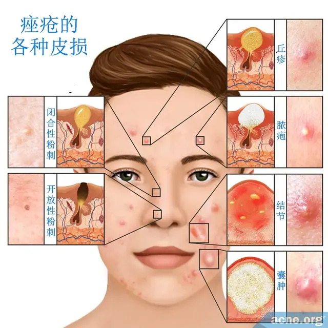 痤疮 VS 玫瑰痤疮，傻傻分不清楚 