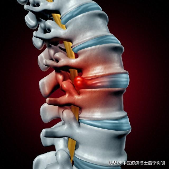 腰椎间盘突出不要怕，3个办法好得快！ 