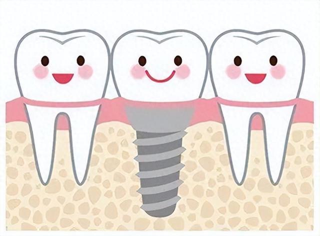 2024正规医院种植牙收费标准，含一颗|多颗|全口|半口种植牙价格 