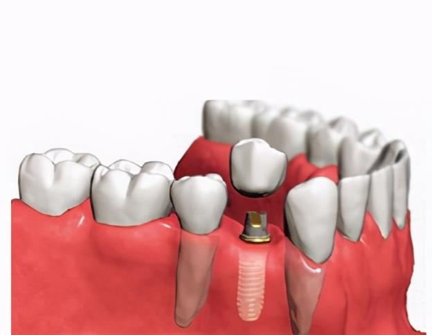 做种植牙会有什么后遗症？主要有以下几点 