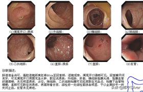 溃疡性结肠炎半年，中医治疗基本痊愈，感慨：终于不用以厕所为家 