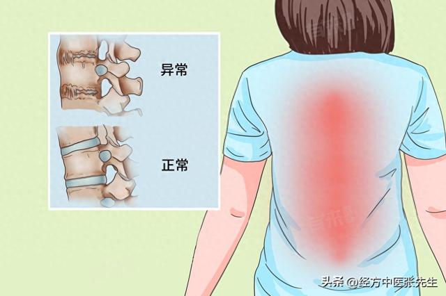 牵正散合阳和汤合补阳还五汤加减治疗强直性脊柱炎 