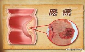 晨起哪种大便预示有肠癌？一文教你如何在大便中发现肠癌的端倪 