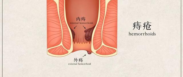 肠道出血和痔疮出血有哪些区别？ 