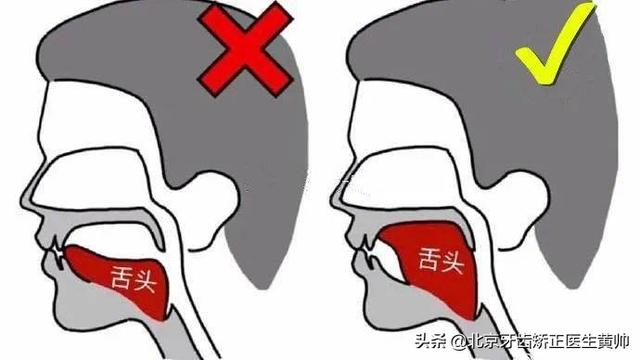 戴过牙套（矫正牙齿）的人脸型都变了吗？ 