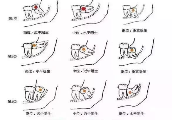 80%的智齿都要拔掉，除非是这3种情况…… 