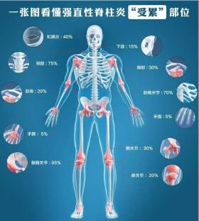 一张图看懂强直性脊柱炎“受累”部位，4种方法预防强直性脊柱炎 