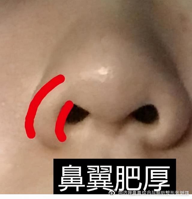 鼻头肥厚有哪些术式可以改善？ 