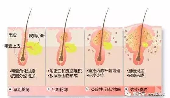 痘痘分四种，治疗它们差别很大，千万别乱挤 