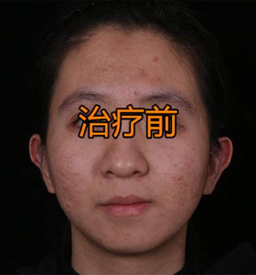 张女士激光治疗后，5年痘坑痘印彻底消失，现在感觉自信了很多 