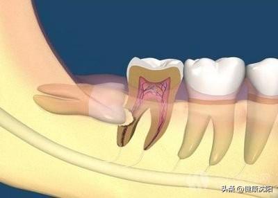 【健康知识普及行动】口腔预防保健之智齿和疼痛的牙齿一定要拔除吗？ 