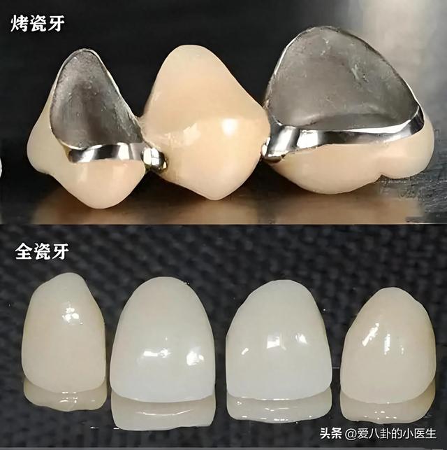 烤瓷牙和全瓷牙到底该如何选择？ 