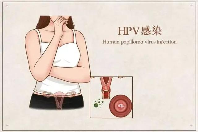 HPV52阳性怎么办呢？ 