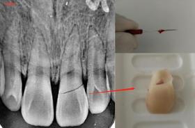 牙齿断了一半怎么处理最好 