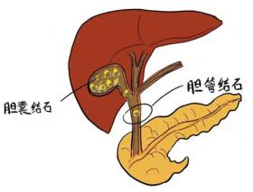 四川胆结石医院科普：胆囊结石可以采取激光碎石吗？ 