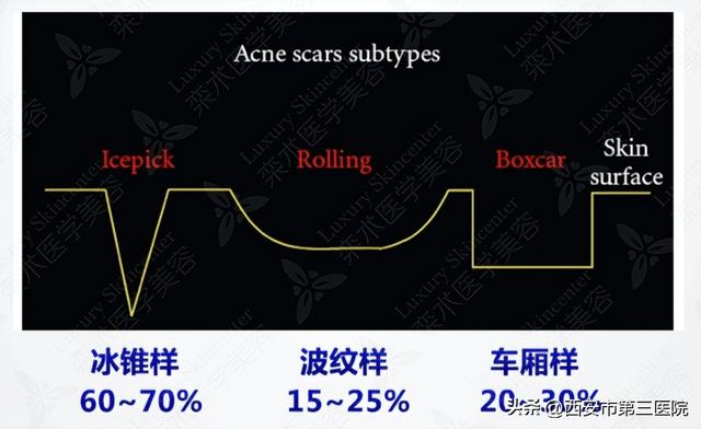 焕“颜”一新｜脸上有痘坑，用微针还是点阵激光好呢？ 